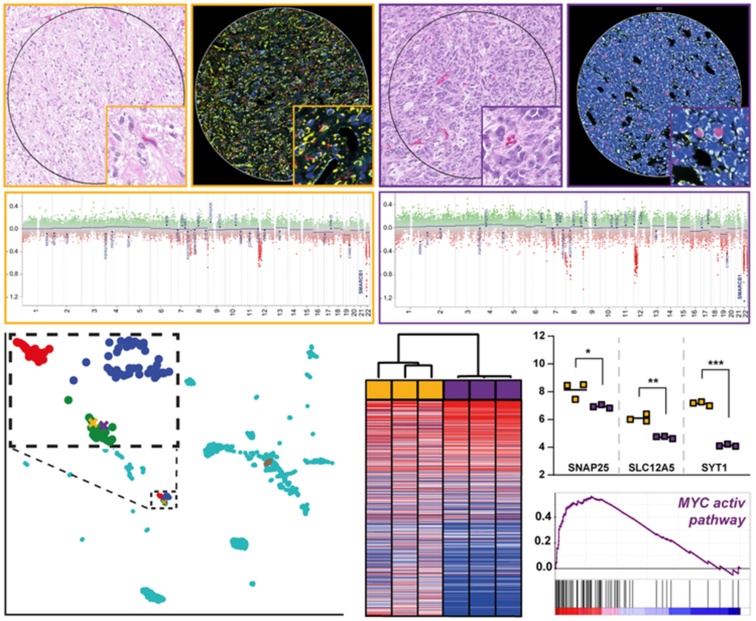 Spatial molecular profiling of a central nervous system low‐grade diffusely infiltrative tumour with INI1 deficiency featuring a high‐grade atypical teratoid/rhabdoid tumour component