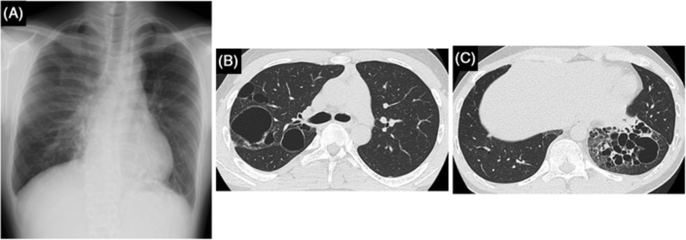 Chronic pulmonary aspergillosis in a patient with hyper‐IgE syndrome