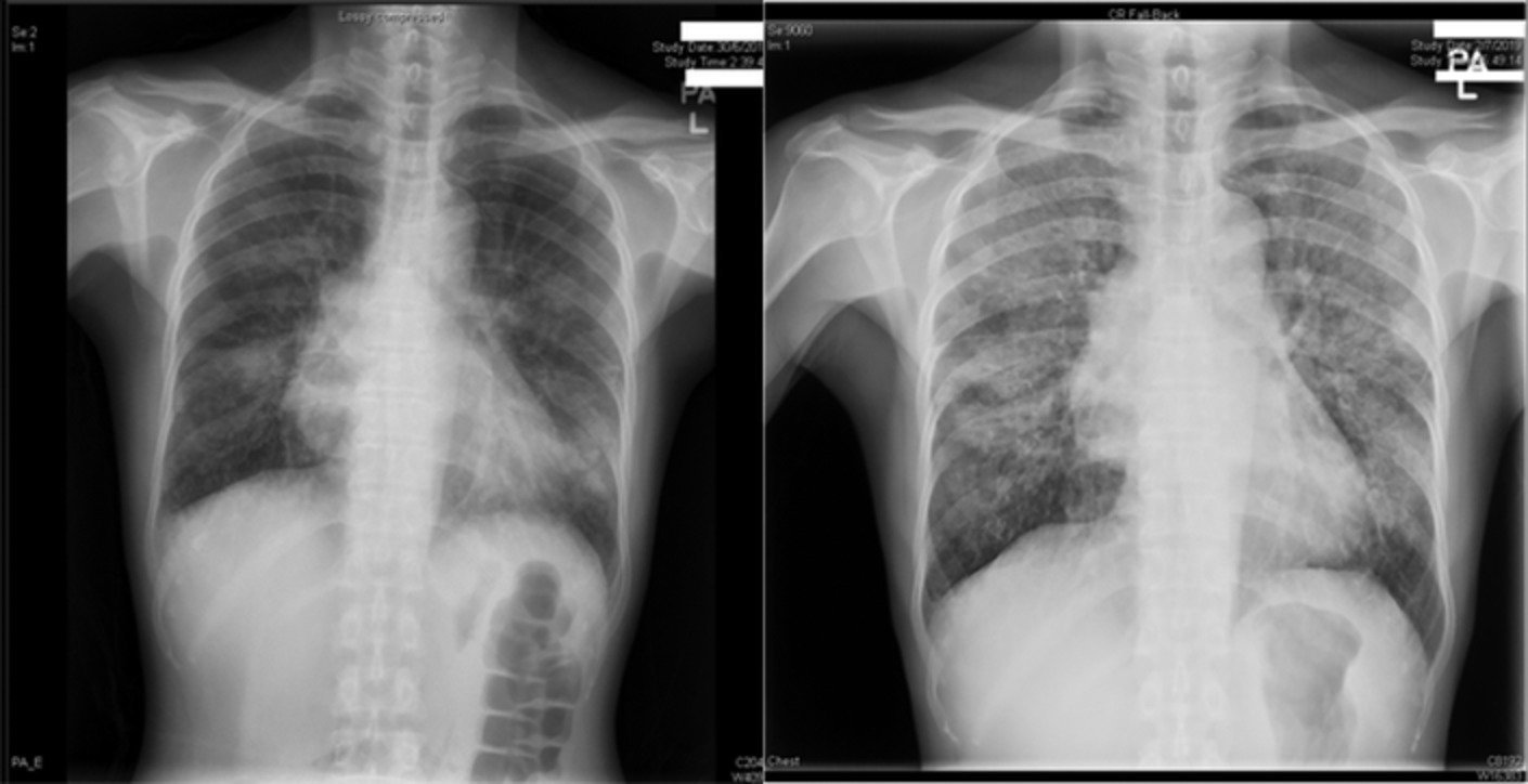 Good's syndrome presenting with CMV pneumonitis and oesophageal candidiasis: A case report