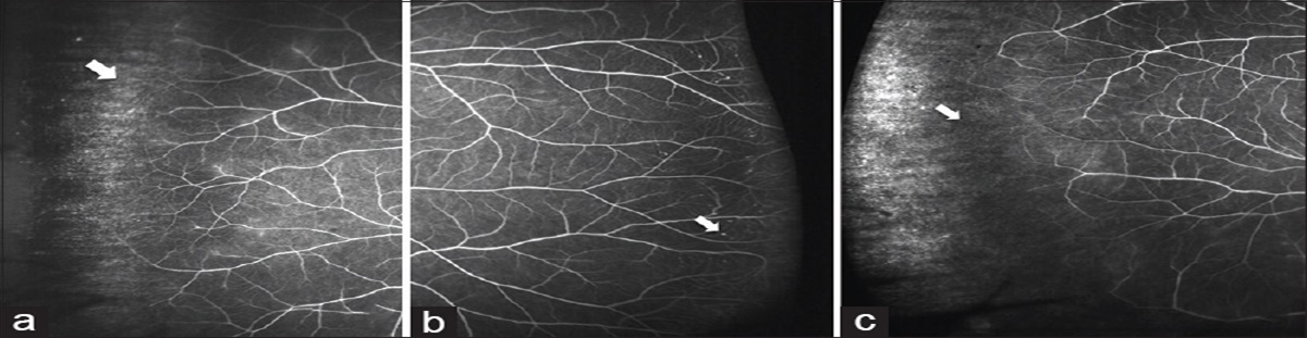 Ultra-wide field retinal imaging: A wider clinical perspective