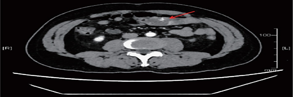 Anticancer effects of dietary administration of secoisolariciresinol diglucoside in a patient of gastrointestinal stromal tumor: a case report