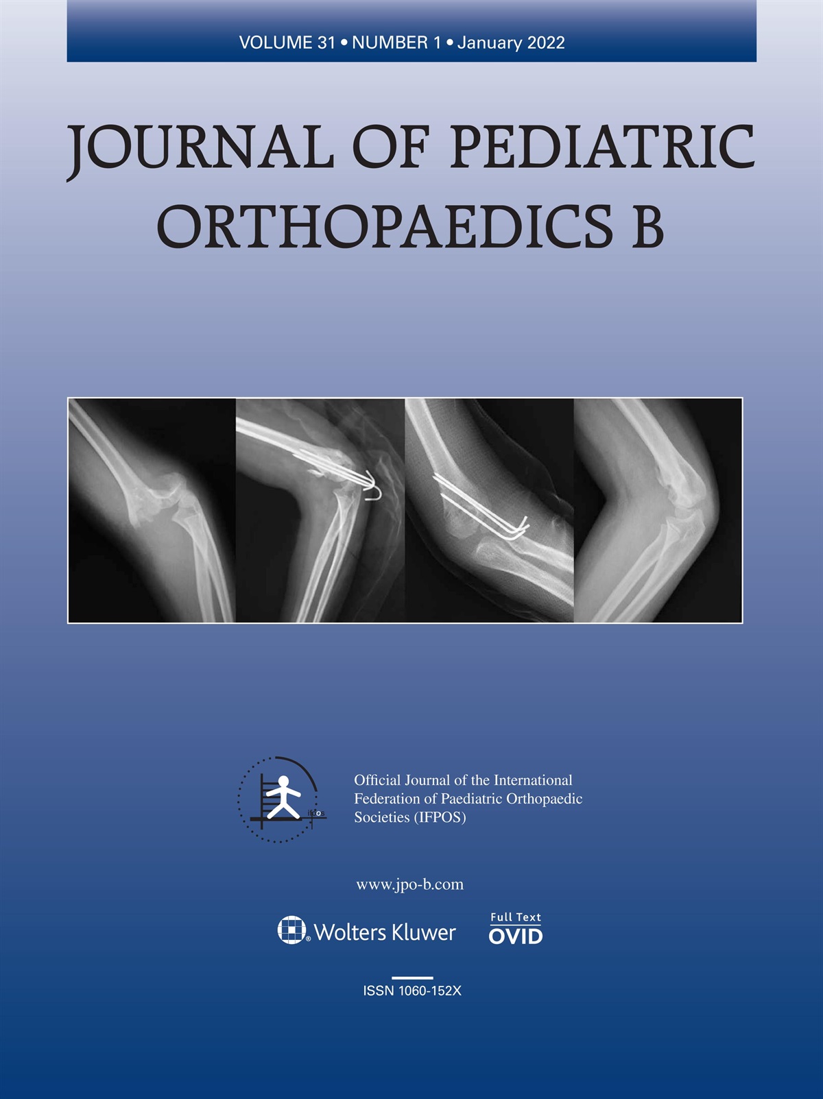 Minimally displaced pediatric humerus lateral condyle fractures: risk factors for displacement and outcomes of delayed surgery – Edmonds EW, Bland DC, Bastrom TP, Smith MM, Upasani VV, Yaszay B, Pennock AT. J Pediatr Orthop B 2021; 30:167–173