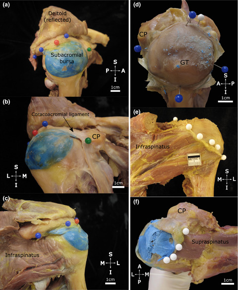 The morphology of the subacromial and related shoulder bursae. An anatomical and histological study
