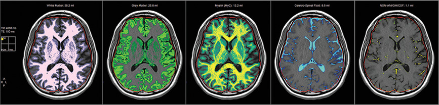Relaxation time of brain tissue in the elderly assessed by synthetic MRI