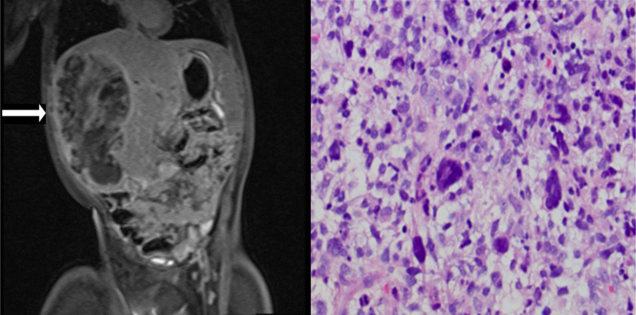 Embryonal sarcoma of the liver in a girl with Cockayne syndrome