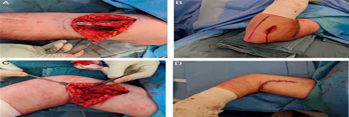 Distal Biceps Tendon Ruptures: Acute Repair Versus Chronic Reconstruction Using the “Anatomic Length Method” and Concomitant Bicipital Aponeurosis Repair: A Group-matched Comparative Retrospective Study