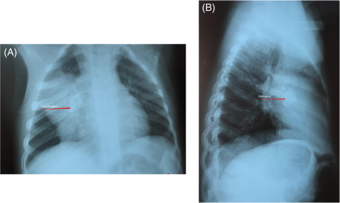 Inflammatory myofibroblastic tumour of the lung: Case report and review of the literature