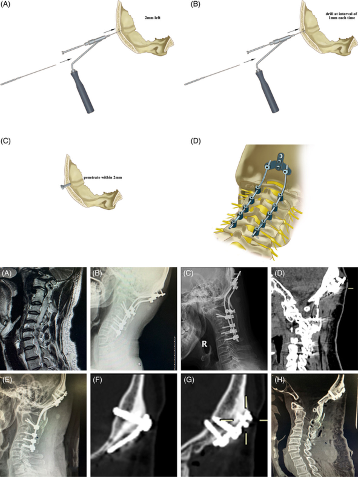 Occipitocervical Revision Surgery Using the Bicortical Screw and Plate System for Failed Craniovertebral Junction Stabilization