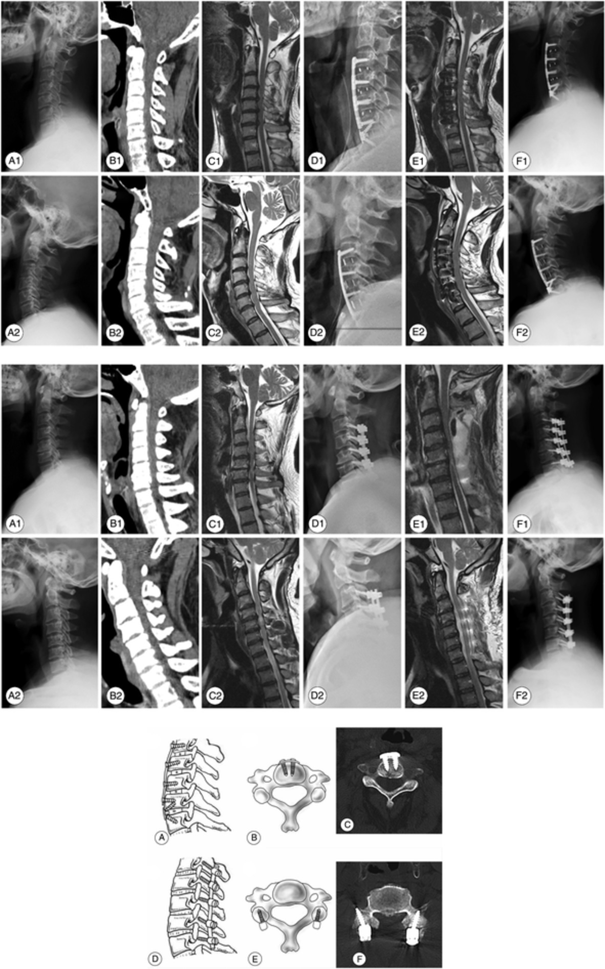 Comparison of Anterior Cervical Discectomy and Fusion with Cervical Laminectomy and Fusion in the Treatment of 4‐Level Cervical Spondylotic Myelopathy