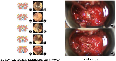 Comparison of the Clinical Outcomes of Full‐Endoscopic Visualized Foraminoplasty and Discectomy Versus Microdiscectomy for Lumbar Disc Herniation