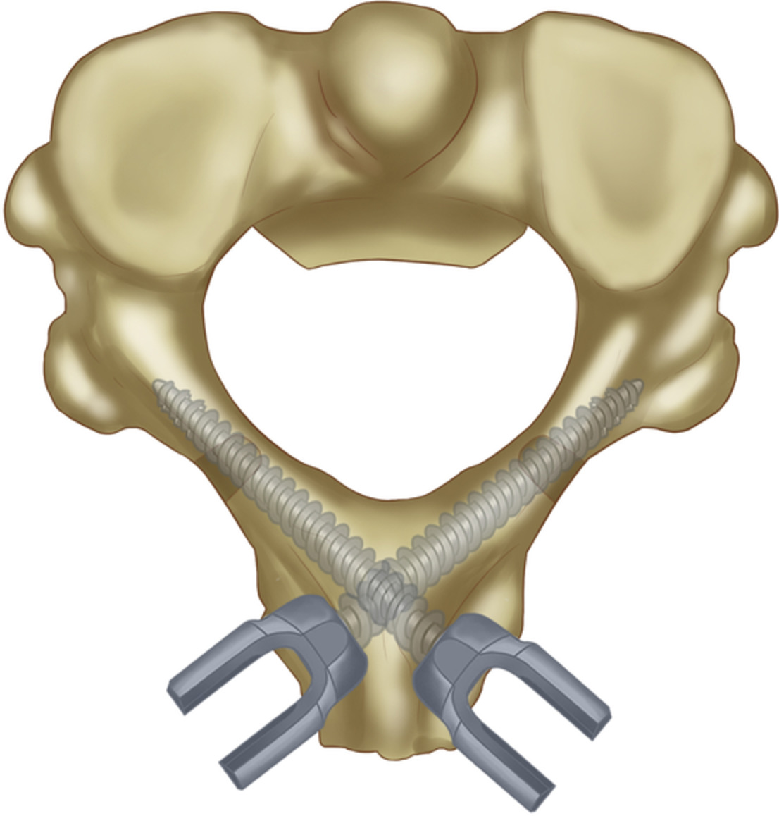 Wright's Technique with the Addition of Visualized Axial Cortical Windows in Odontoid Fractures