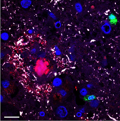 No evidence of aberrant amyloid β and phosphorylated tau expression in herpes simplex virus‐infected neurons of the trigeminal ganglia and brain