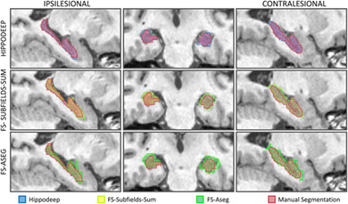 Testing a convolutional neural network‐based hippocampal segmentation method in a stroke population