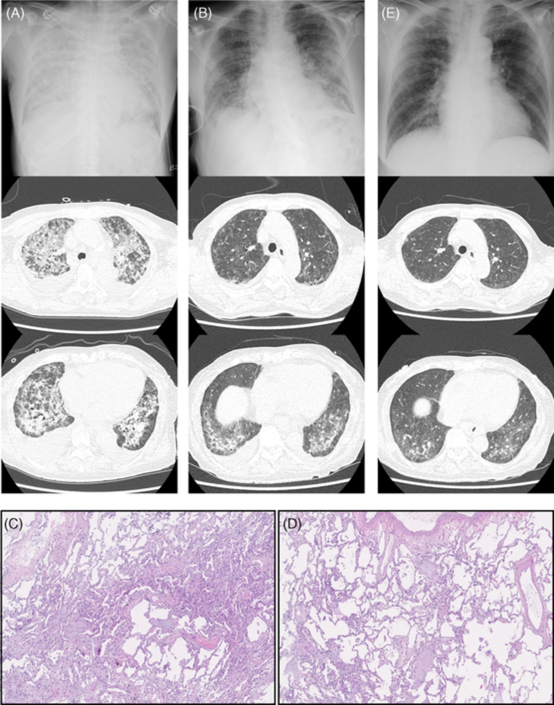 Cryobiopsy for Pneumocystis jirovecii pneumonia secondary to adult T‐cell lymphoma/leukaemia