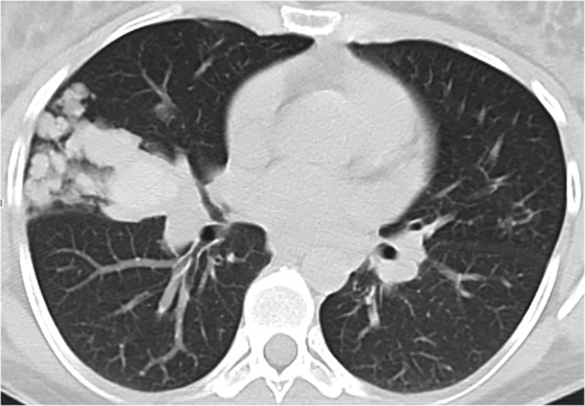 Congenital pulmonary airway malformation: A rare diagnosis in adulthood