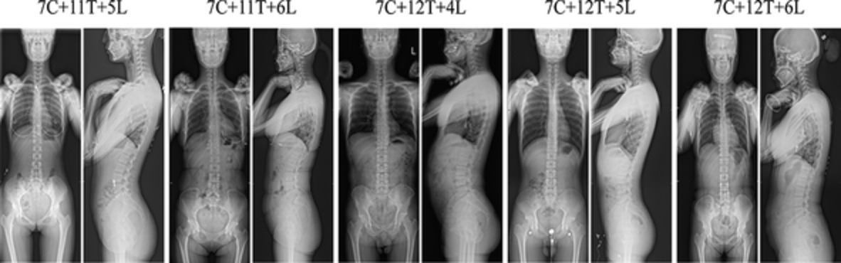 Variation in Global Spinal Sagittal Parameters in Asymptomatic Adults with 11 Thoracic Vertebrae, four Lumbar Vertebrae, and six Lumbar Vertebrae