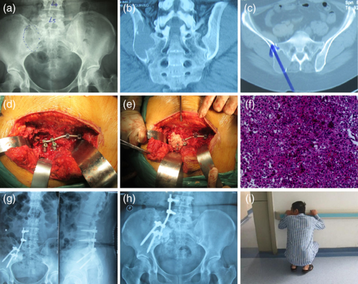 Bone cement filling combined with lumbo‐iliac screw internal fixation in the treatment of benign sacroiliac joint tumours