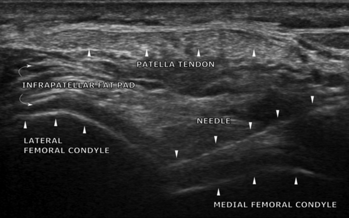 Ultrasound guided anterior approach to intra‐articular injection of the knee