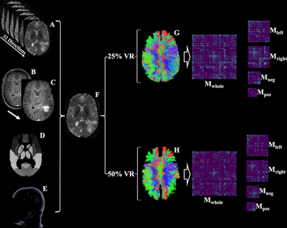 Elucidating the structural–functional connectome of language in glioma‐induced aphasia using nTMS and DTI