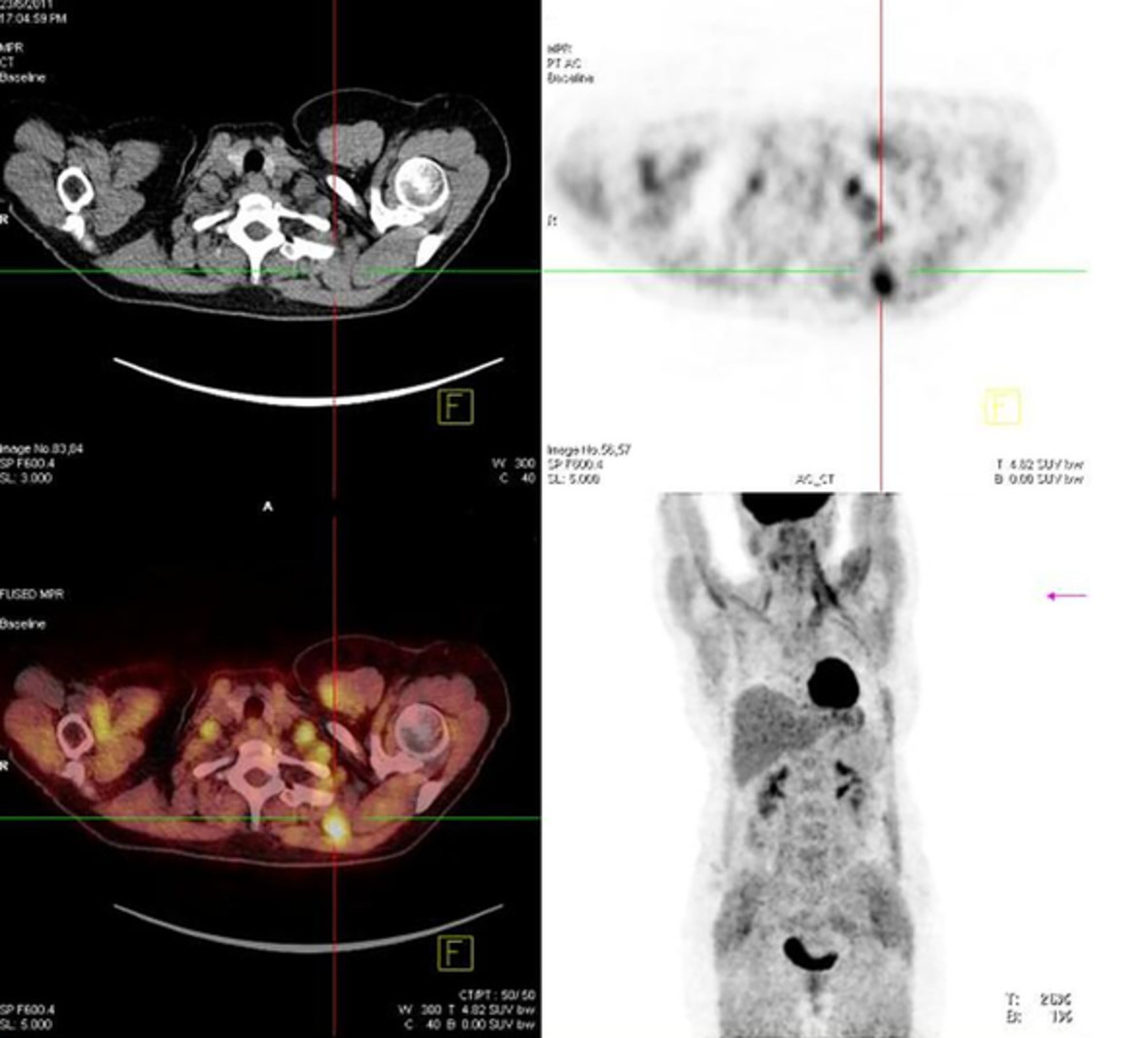 Muscular sarcoidosis in the eyes of 18F‐FDG PET/CT