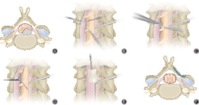 Cervical Transdural Discectomy with Laminoplasty for the Treatment of Multi‐segment Cervical Spinal Stenosis Accompanied with Cervical Disc Herniation: Technical Note and Clinical Outcome