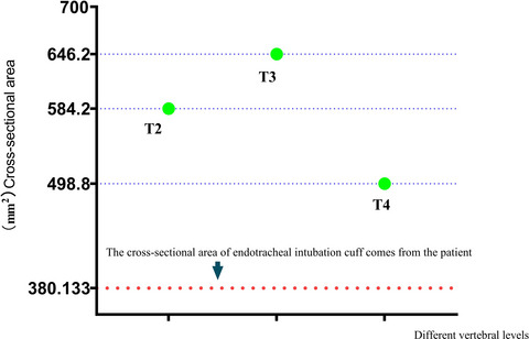 Endotracheal cuff undersizing diagnosed by computed tomography: Case report