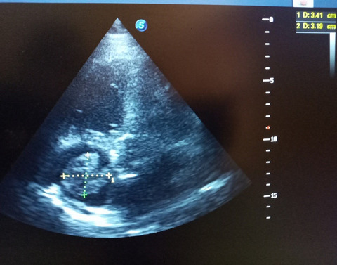 Triple emergencies: Hyperosmolar hyperglycemic state, venous thromboembolism, and huge free‐floating right heart thrombus successfully managed with anticoagulation