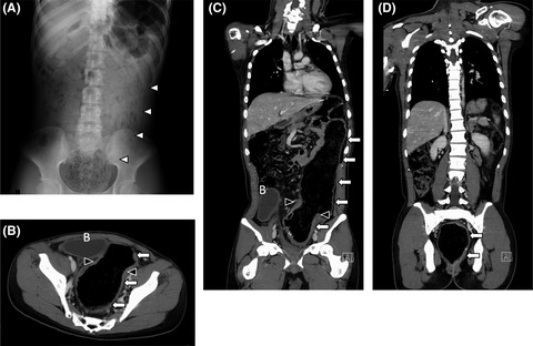 Stercoral ulcer after Hirschsprung's disease surgery