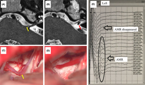 Microvascular decompression and aneurysm clipping for a patient with hemifacial spasm and ipsilateral labyrinthine artery aneurysm: A rare case report and literature review