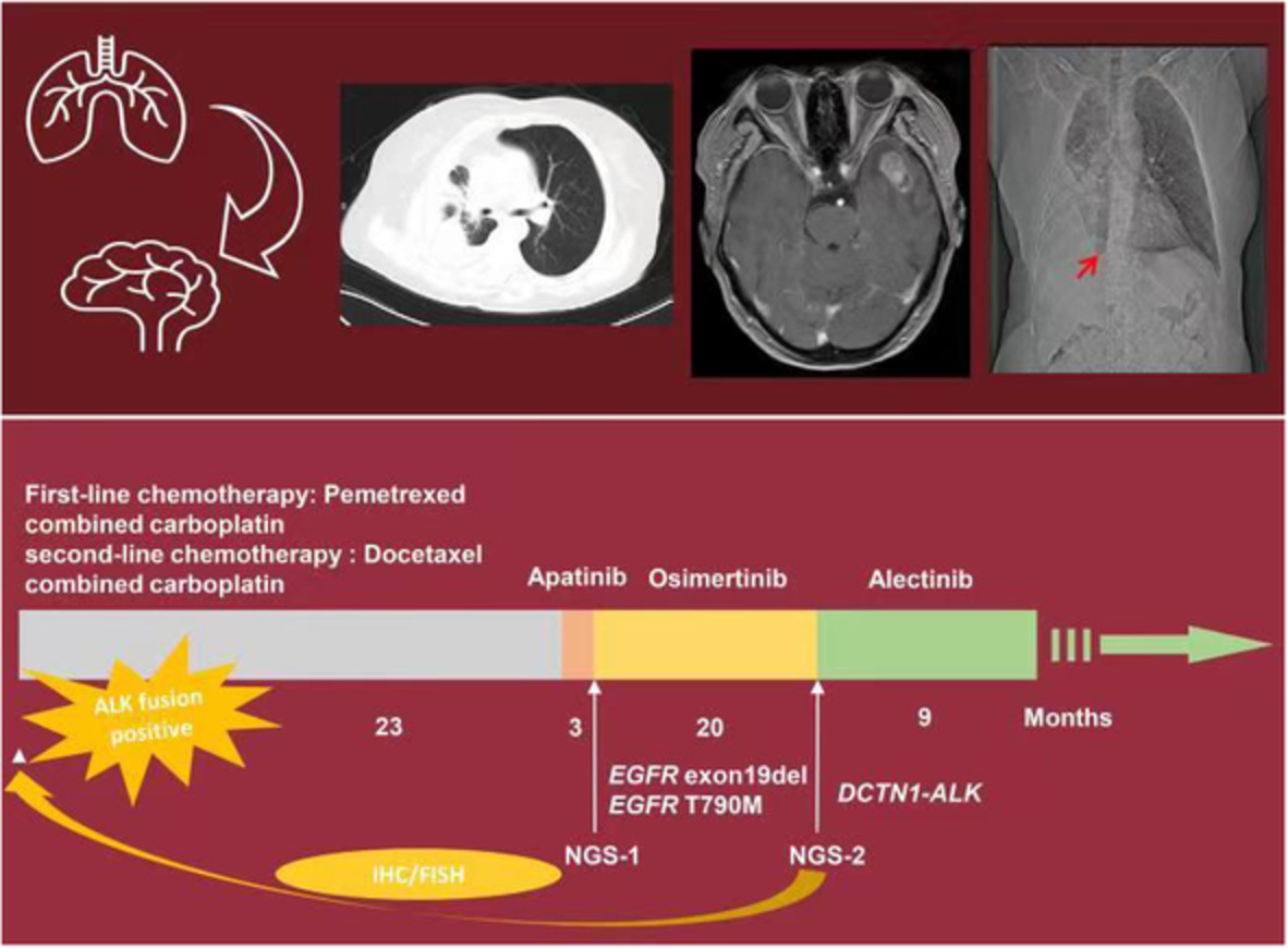 Effectiveness of alectinib and osimertinib in a brain metastasized lung adenocarcinoma patient with concurrent EGFR mutations and DCTN1‐ALK fusion