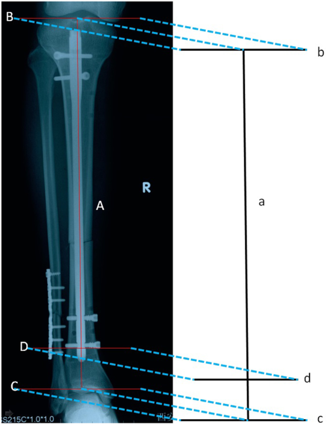 An Approach to Intraoperatively Identify the Coronal Plane Deformities of the Distal Tibia When Treating Tibial Fractures with Intramedullary Nail Fixation: a Retrospective Study