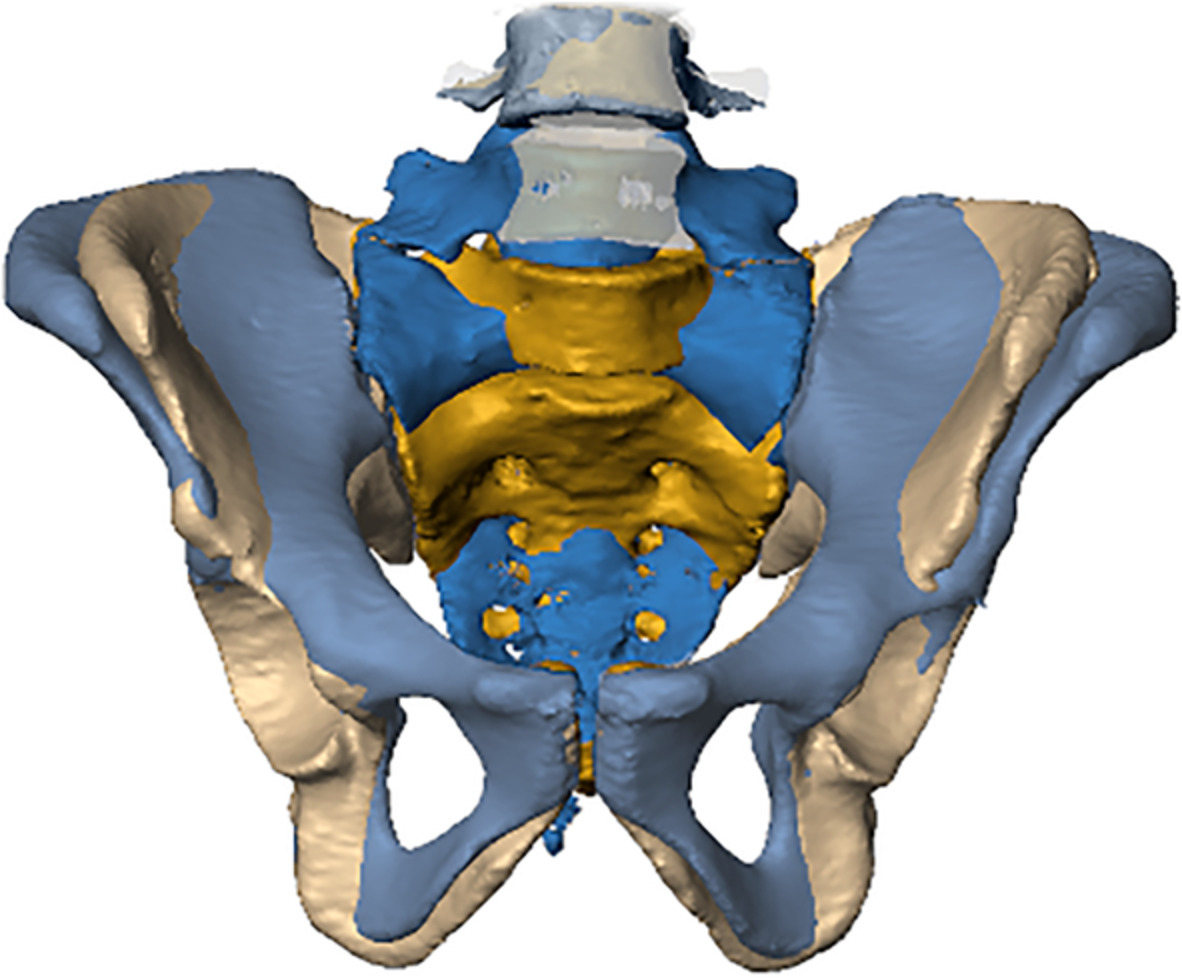 The morphological consequences of segmentation anomalies in the human sacrum
