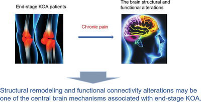 Altered brain activity in end‐stage knee osteoarthritis revealed by resting‐state functional magnetic resonance imaging