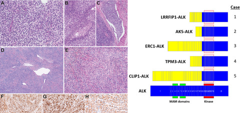 ALK rearrangements in infantile fibrosarcoma‐like spindle cell tumours of soft tissue and kidney