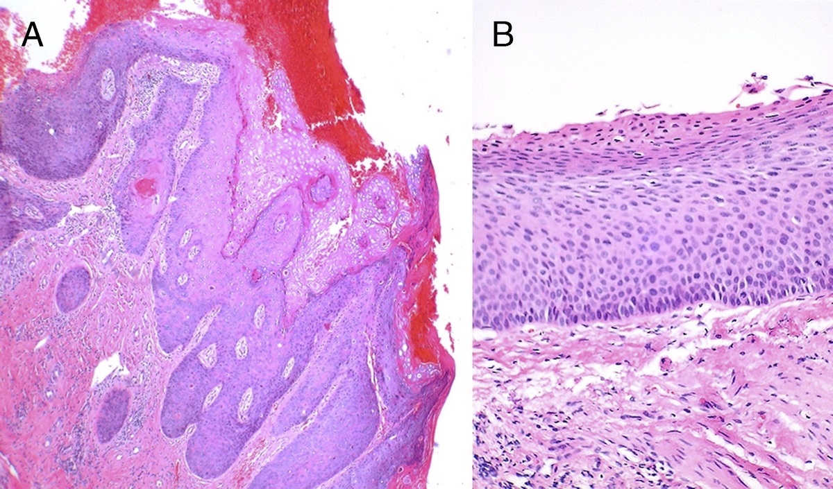 Vulvar High-Grade Squamous Intraepithelial Lesions and Cancer as a Risk Factor for Anal Cancer: A Review