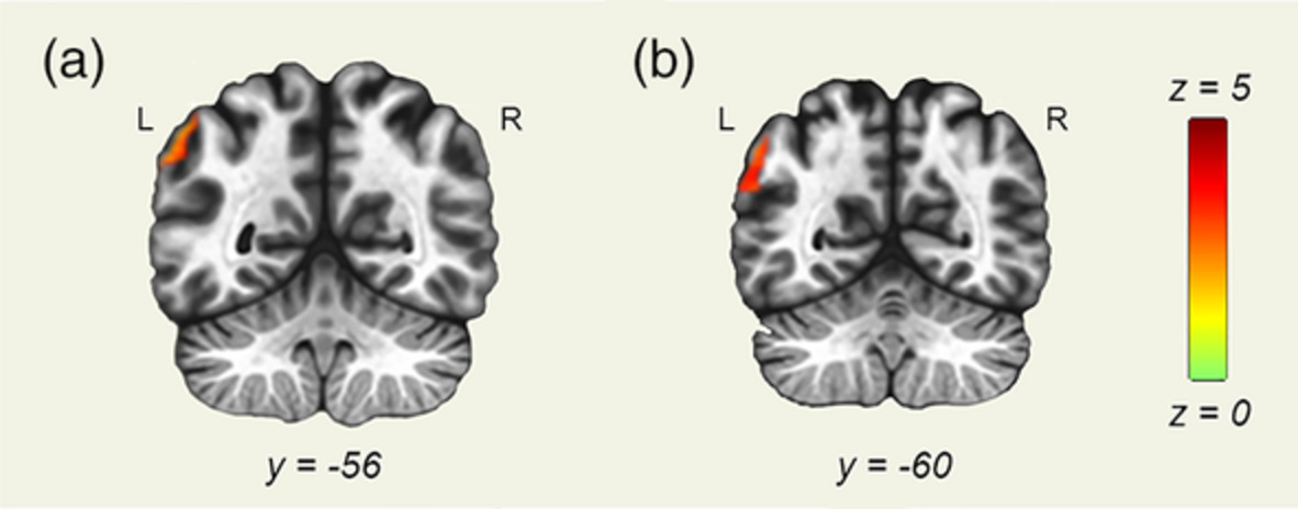 The role of visual attention in dyslexia: Behavioral and neurobiological evidence