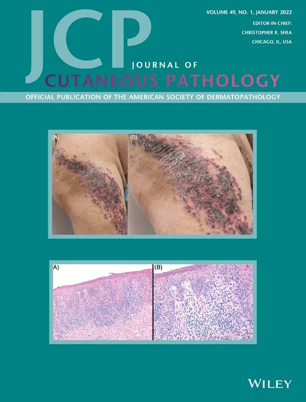 A case of cutaneous syncytial myoepithelioma with extensive adipocytic metaplasia: Usefulness of EWSR1‐PBX3 gene fusion analysis