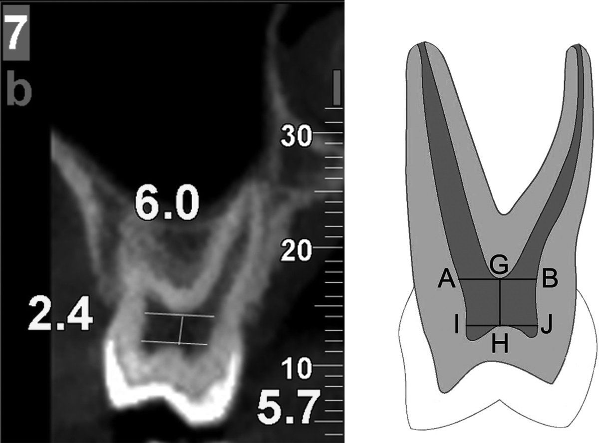 A Radio-Odontometric Analysis of Sexual Dimorphism in First Molars Using Cone-Beam Computed Tomography