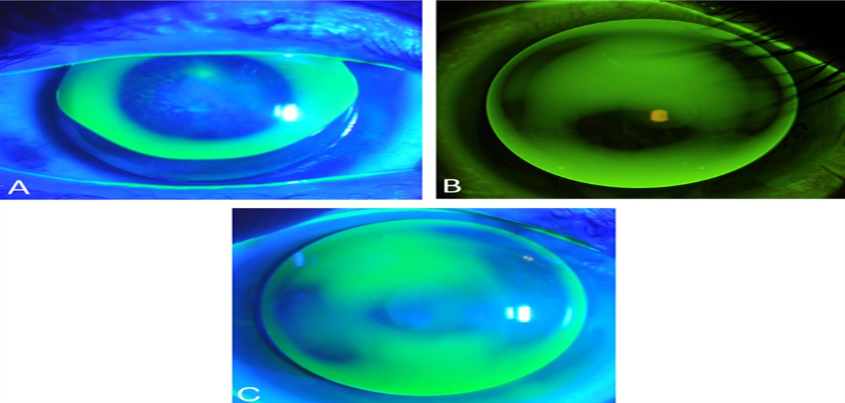 Management of Keratoconus With Corneal Rigid Gas-Permeable Contact Lenses