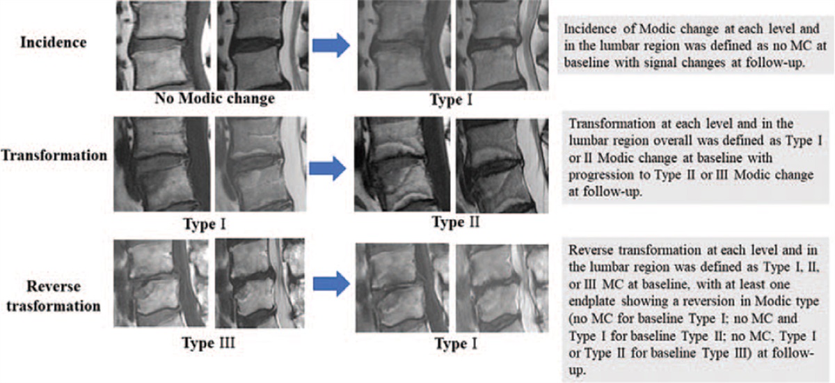 A Prospective, 3-year Longitudinal Study of Modic Changes of the Lumbar Spine in a Population-based Cohort: The Wakayama Spine Study