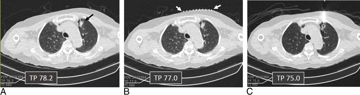 Is Free Breathing Possible During Computed Tomography–Guided Percutaneous Transthoracic Lung Biopsy? The Clinical Experience in 585 Cases