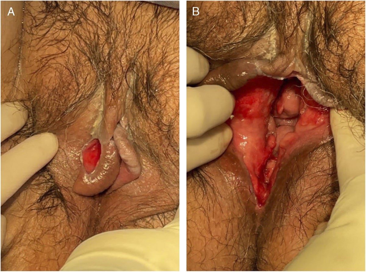 Vulvovaginal Pyoderma Gangrenosum in a Patient Treated With Ocrelizumab for Multiple Sclerosis