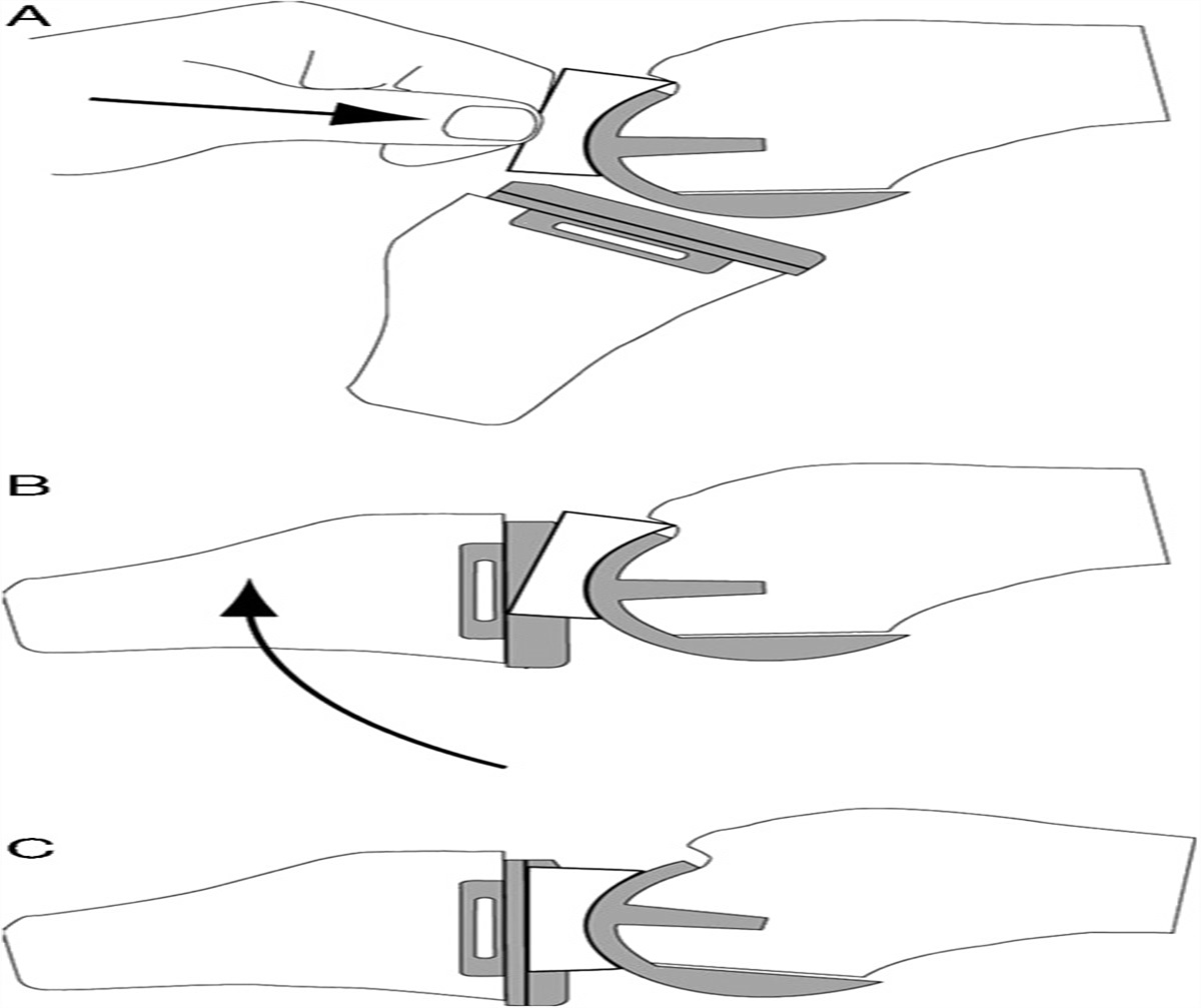 A Novel Technique to Aid Insertion of the Mobile Meniscal Bearing of the Oxford Unicompartmental Knee Arthroplasty