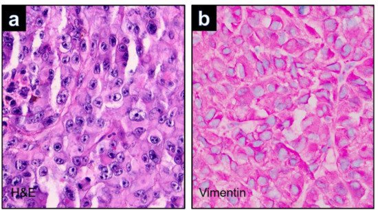 Dermatopathology, Vol. 9, Pages 148-157: PRAME Expression as Helpful Immunohistochemical Marker in Rhabdoid Melanoma