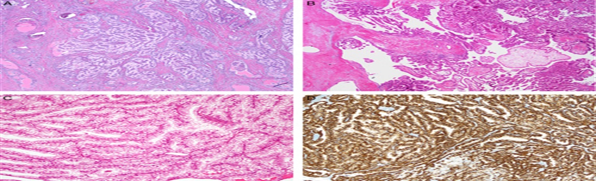 Renal Cell Carcinoma With Fibromyomatous Stroma—The Whole Story