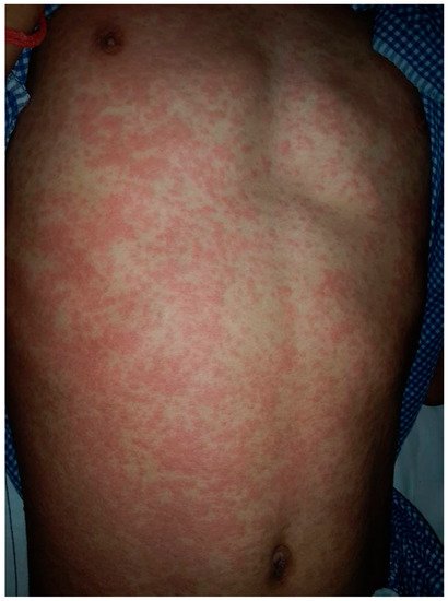 Dermatopathology, Vol. 9, Pages 164-171: Drug-Induced vs. Viral Maculopapular Exanthem—Resolving the Dilemma