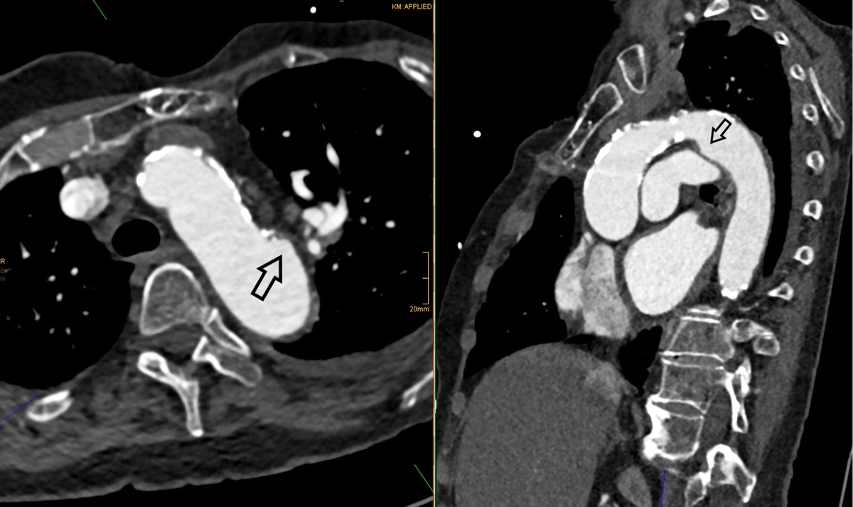 The Aortic Ductus Diverticulum—Innocent Bystander or Potential Source of Thromboembolic Stroke?