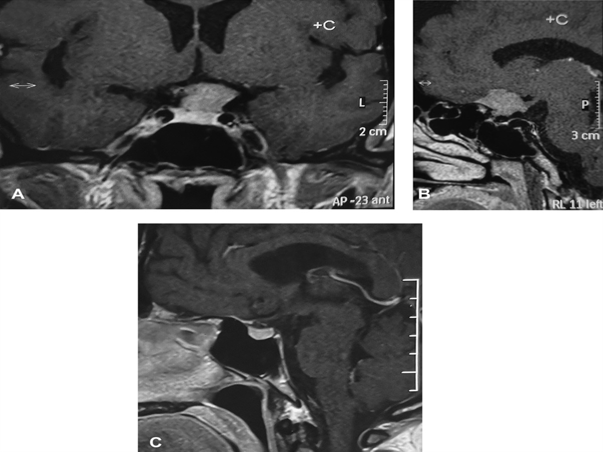 Pendular Seesaw Nystagmus: Disappearance With Monocular Occlusion