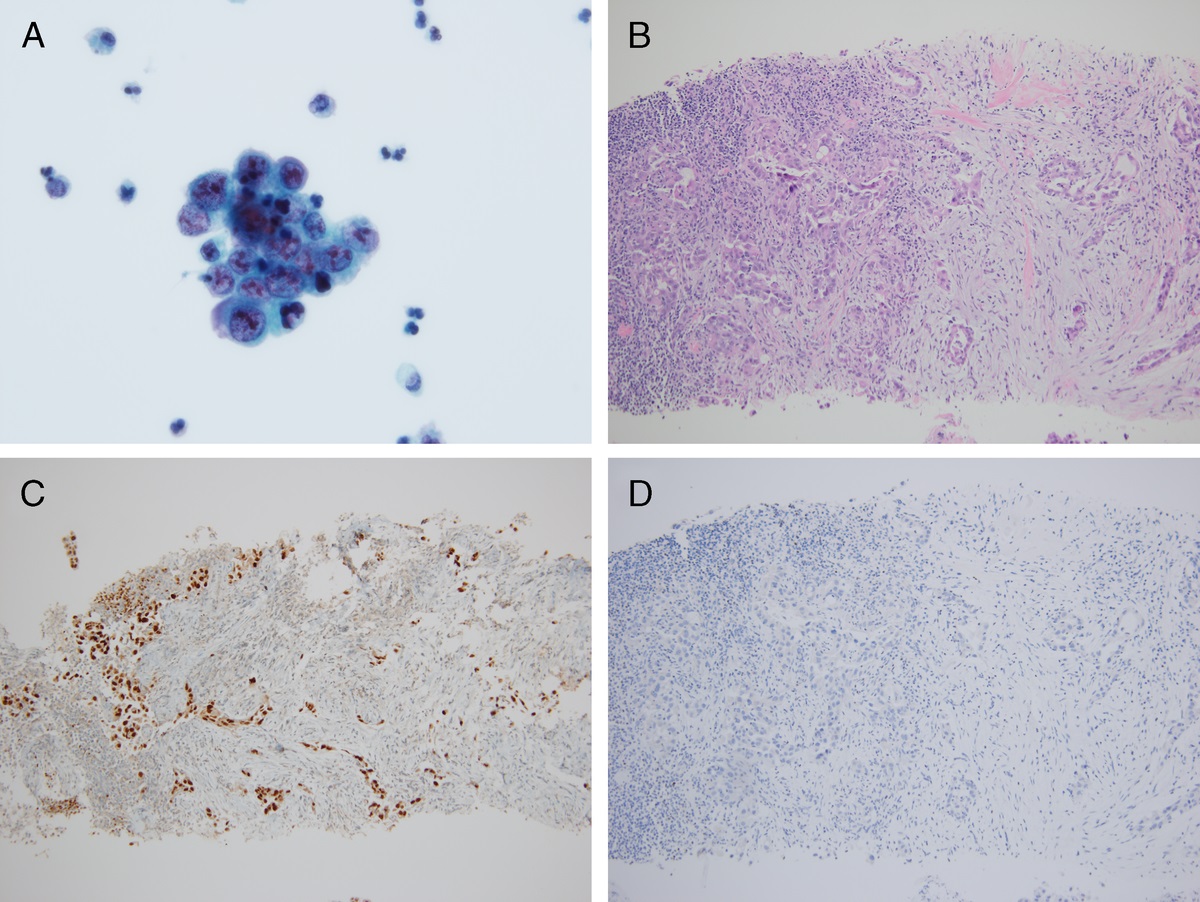 Malignant Cells in Urine Cytology: Not Always High-Grade Urothelial Carcinoma