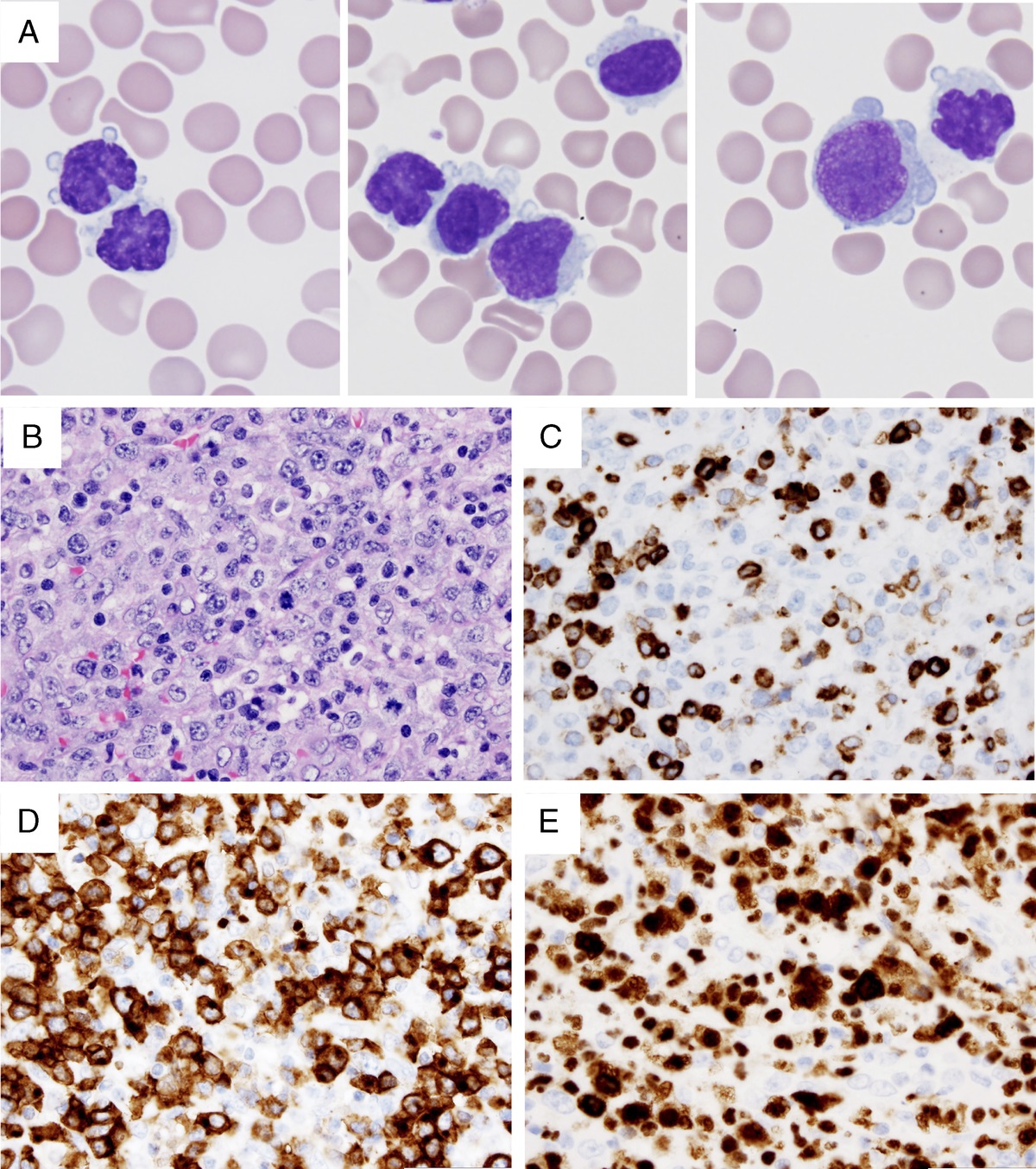 Leukemic Presentation of Anaplastic Large Cell Lymphoma: A Diagnostic Challenge Mimicking T-Cell Prolymphocytic Leukemia